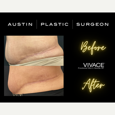 18-24 year old woman treated with Vivace - VIVACE scar treatment in San Antonio TX