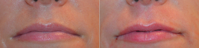 35-44 year old woman treated with Belotero - Belotero injections for lip rejuvenation and contouring/shaping.