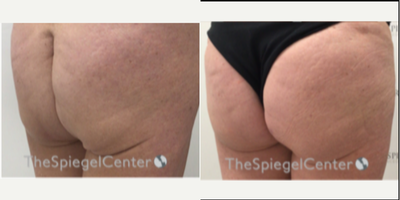 Woman treated with Nonsurgical Butt Lift - Woman treated with Nonsurgical Butt Lift