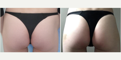 Woman treated with Nonsurgical Butt Lift - Woman treated with Nonsurgical Butt Lift