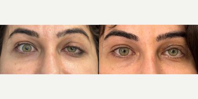 Woman treated with Ptosis Surgery - After undergoing periocular cosmetic surgery and subsequent revision surgery performed elsewhere, she experienced significant damage to her levator muscle, resulting in ptosis. Following the repair of the levator muscle, her appearance achieved a nearly symmetrical outcome. I am pleased to have been able to help her out, especially because she was feeling so down and miserable about it.