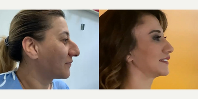36 year old woman treated with Cheek Lift - 36 year old woman treated with Cheek Lift as well as Deep Plane Facelift, Rhinoplasty, Eyelid Surgery, Neck Lift, Brow Lift, and Facial Fat Transfer (lips and around the eyes), shown 10 months post op.