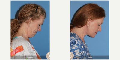62 year old woman treated with Deep Plane Facelift, Neck Lift, Botox, MACS Facelift - 62 year old woman treated with Deep Plane Face and Neck Lift, Fat Grafting to Cheeks, Botox, MAC