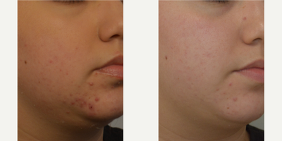 18-24 year old woman treated with Acne Treatment - Active acne as well as post inflammatory hyper-pigmentation from previous breakouts and some light scaring. Treated with a blended chemical peel containing Salicylic acid 14%, Lactic Acid 14%, kojic acid 3%, and Citric acid known as PCA Chemical Peel (hydroquinone free) with home care regimen of salicylic face wash, retinol, and hyaluronic acid serum, sunscreen.