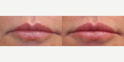45-54 year old woman Lip Enhancement with Revanesse Versa - This is a subtle enhancement using Revanesse. Not all patients want large lips.
