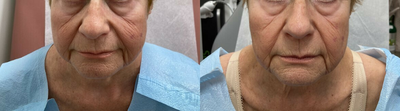 Woman treated with Secret RF - Patient had Secret RF micro-needling x 3 treatments