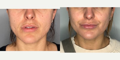 35-44 year old woman treated with Microneedling - patient had a series of microneedling with PRP