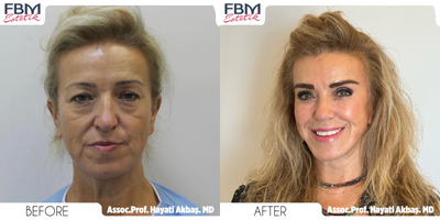35-44 year old woman treated with Mini Facelift, Cheek Lift, Brow Lift, Facial Fat Transfer, Mini Neck Lift - 35-44 year old woman treated with Mini Facelift, Cheek Lift, Brow Lift, Facial Fat Transfer, Mini Neck Lift