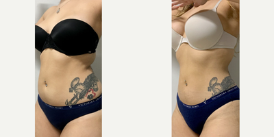 35-44 year old woman treated with CoolSculpting - The patient was treated with two cycles of Coolsculpting on her abs, between 3 weeks.