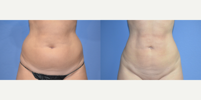 35-44 year old woman treated with BodyTite - 43 y/o female shown 3 months after BodyTite liposuction to her abdomen and flanks. A total of 3 L was removed.
