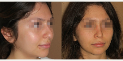 Woman treated with Rhinoplasty - Woman treated with Rhinoplasty
