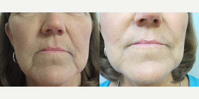 45-54 year old woman treated with Juvederm - This patient softened her Per-Oral area with Juvederm