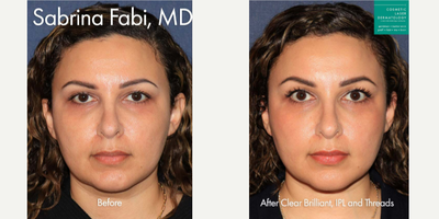 35-44 year old woman treated with Clear and Brilliant, IPL, Thread Lift - Combination of Clear+Brilliant laser, IPL, and thread lift used to lift and smooth the face of a female patient.
