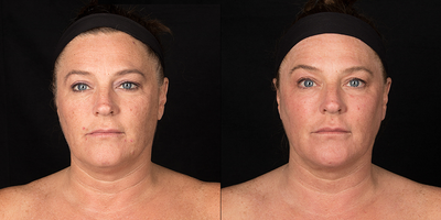 Woman treated with Renuvion - Woman treated with Renuvion