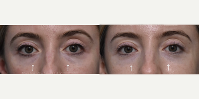 25-34 year old woman treated with Skin Rejuvenation - Woman in her early 30s. Before & after 2 sessions of Ezgel PRF to undereyes for skin rejuvenation. These are healed results, 2 months after 2nd session.