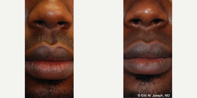 18-24 year old man treated with Lip Reduction - Our handsome 21 year old patient was self conscious about the appearance of his lower lip. He felt that it was droopy, and that there was too much pink mucous membrane showing while his mouth was open. These photos demonstrate a natural looking lower lip appearance 10 months after lower lip reduction surgery. His scar is invisible on the inside of his lower lip, and you can see less droopiness and less pink mucous membrane showing.