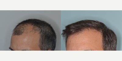 35-44 year old man treated with FUE Hair Transplant - 40 year old male.  Before and After 2,200 FUE grafts to restore frontal hair loss.