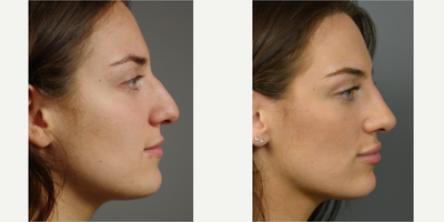 18-24 year old woman treated with Nonsurgical Nose Job - Patient had always wanted to tweak her nose, just a bit, to enhance her profile. The doctorwas able to give her a subtle, natural result after 1 treatment with 0.4 ml of Juvederm Ultra XC.