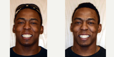 35-44 year old man treated with Six Month Smiles - Patient wanted a quick and effective way to straighten his smile.