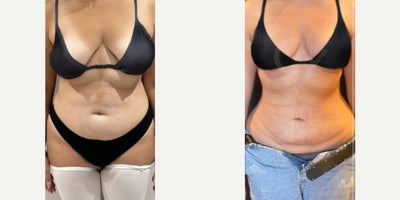 45-54 year old woman treated with Breast Reduction, Liposuction - 45-54 year old woman treated with Breast Reduction, Liposuction