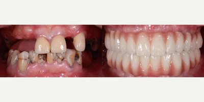 45-54 year old man treated with Full Mouth Reconstruction - Full mouth fixed Prosthesis- 8 Screws upper and 8 lower, teeth on zirconium crownsProcedure Duration-1st visit 7 days for operation & temporary prosthesis2nd visit (after 3 months following the first visit) 7 days for prosthesis treatment