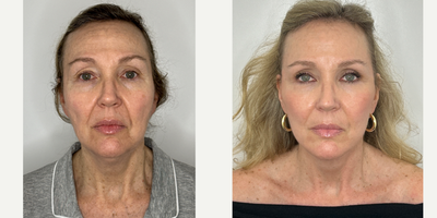 55-64 year old woman treated with Facelift, Neck Lift, Eyelid Surgery, Facial Fat Transfer, CO2 Laser - 58 year old patient 2 months after Facelift, Neck lift, Upper Eyelid Blepharoplasty, Facial Fat transfer and laser rejuvenation.