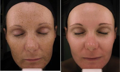 25-34 year old woman treated with Retin-A - 34-year-old female patient with pigmentation and brown spots across her face due to sun damage.Picture taken 8 weeks after ZO skincare home-kit usage which reduced pigmentation and improved skin quality.
