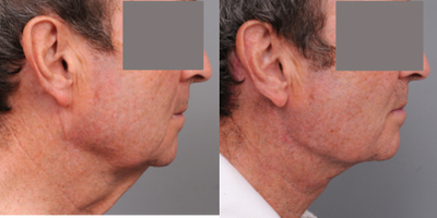 66 year old Male Treated for Loose Neck Skin - Patient complained about his loose neck skin for several years. He finally decided to do something about it.&nbsp;