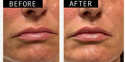 Woman treated with Lip Fillers, Dermal Fillers - This perfect pout was achieved with just 1 syringe of Volbella!