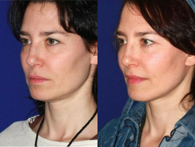 35-44 year old woman treated with Mini Facelift - This young woman was concerned with early aging changes including jowls and some loose skin under the chin. The mini facelift procedure gave her a youthful, more refreshed appearance accentuating her natural beauty and boosting confidence