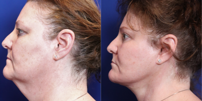 55-64 year old woman treated with Facelift - Primary facelift. Fat injections, 38 cc. Upper lid blepharoplasty, bilateral
