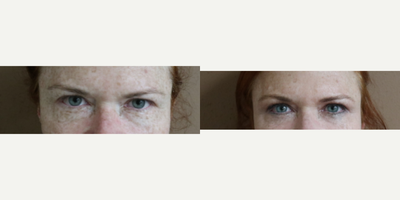45-54 year old woman treated with Eyelid Surgery - Upper eyelid blepharoplasty under local anesthesia.