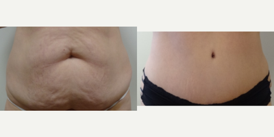 35-44 year old woman treated with Belly Button Surgery - Patient had tummy tuck surgery.
