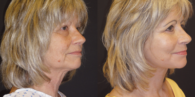 55-64 year old woman treated with Facelift - QuickLift (Facelift) Neck Extension, Neck Liposuction, Fat Transfer: Perioral and Cheeks, Chemical Peel, Subperiosteal Brow Lift, Lower Blepharoplasty