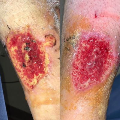 55-64 year old woman treated with EVLT - Leg ulcer, and sever leg pain, patient unabl to walk because of pain ( wheelchair) she has been treated by wound care clinics for 6 months without any improvement, 2 weeks after ablation of refluxing veins in the leg, pain has subsided tremendously, and ulcer started improving.