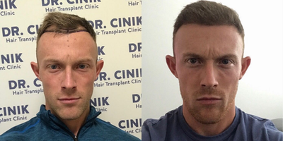 25-34 year old man treated with FUE Hair Transplant - hairline fix with 2800-3000 grafts