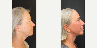 60 year old woman treated with Botox - 60 year old woman treated with Botox as well asDeep Plane Facelift andChemical Peel