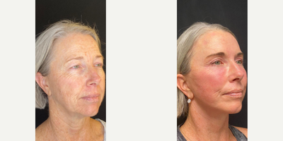 60 year old woman treated with Botox - 60 year old woman treated with Botox as well asDeep Plane Facelift andChemical Peel