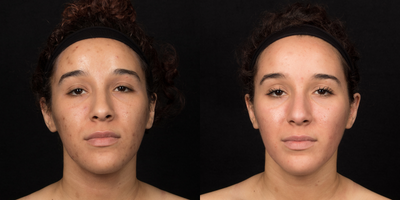 25-34 year old woman with Acne Scars treated with Cosmelan Peel - Patient was concerned with textural and pigmentation irregularities from acne scarring and was treated with a Cosmelan peel to improve texture, color and tone.