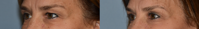 45-54 year old woman treated with Eyelid Surgery - Six weeks following upper eyelid blepharoplasty done under local anesthesia.