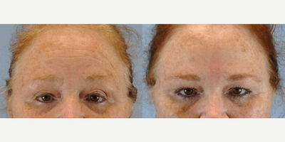 45-54 year old woman treated with Botox - This patient was treated with Botox.