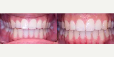 Woman treated with Invisalign - Invisalign treatment was completed to correct an uneven upper smile and to correct a front open bite. Treatment took 14 months to complete.