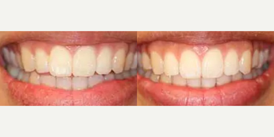 Woman treated with Invisalign - Invisalign treatment was completed to correct an uneven upper smile and to correct a front open bite. Treatment took 14 months to complete.