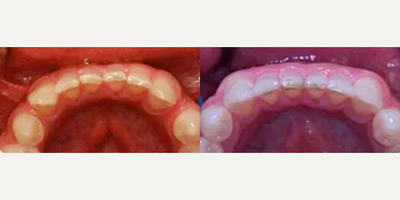Man treated with Invisalign - Patient presented with a chief complaint of a large diastema space between his upper front teeth. Invisalign treatment was used to fully close the space.