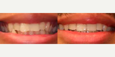 29 year old man treated with Invisalign - 29 year old male presented with the Chief complaint of uneven front buck teeth and constant biting of lip with lower canine in crossbite. Clear aligner treatment was completed in 10 months followed by esthetic enamel reshaping to achieve a more harmonious even looking smile.