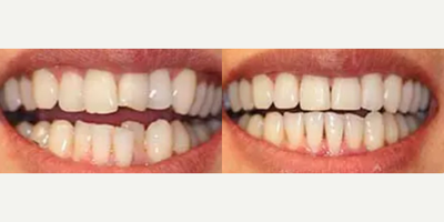 Woman treated with Invisalign - Patient was very unhappy with the look of her teeth. She felt they looked aged and crowded. Invisalign treatment was used to correct the poor angulations and crowding and cosmetic dental bonding was used to correct the chipped and uneven upper front two teeth.