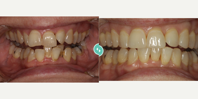 Man treated with Invisalign - Man treated with Invisalign