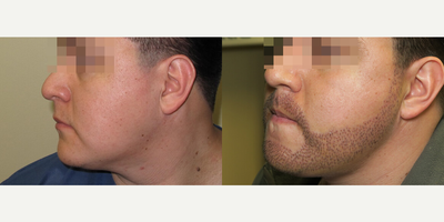 Man treated with Beard Transplant - Man treated with Beard Transplant- 1 week post-op