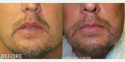 Man treated with Beard Transplant - Man treated with Beard Transplant