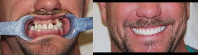 All-on-4 Dental Implants  - All-on-4 Dental Implants&nbsp;